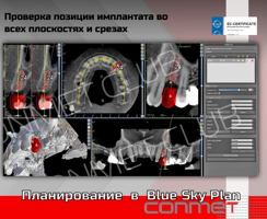 Планирование в  Blue Sky Plan - соблюдении зоны безопастности до анатомических структур и других имплантатов.
